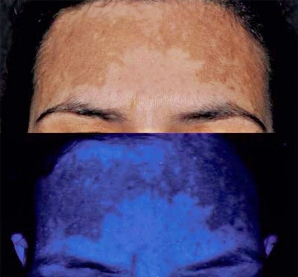 ¿Qué es el melasma y cuál es la causa de su aparición ...